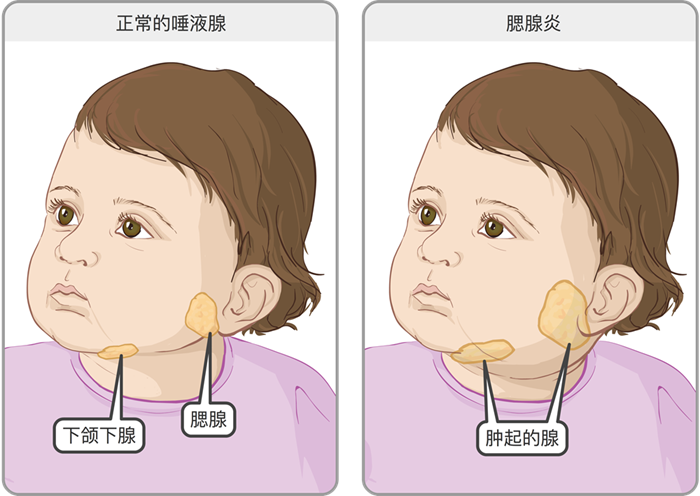 流行性腮腺炎的预防常识