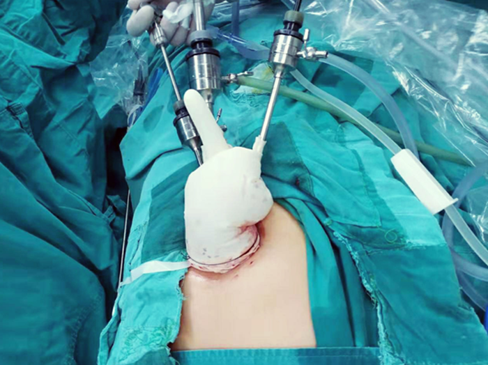 我院妇科团队成功开展区域首例单孔腹腔镜手术